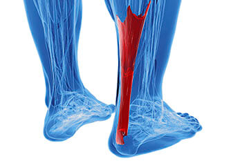 Achilles Tendinitis