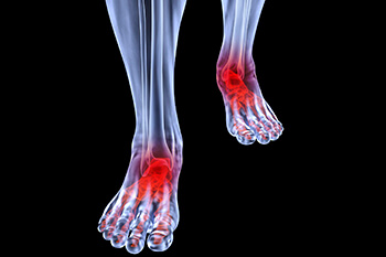 Arthritic Foot & Ankle Care